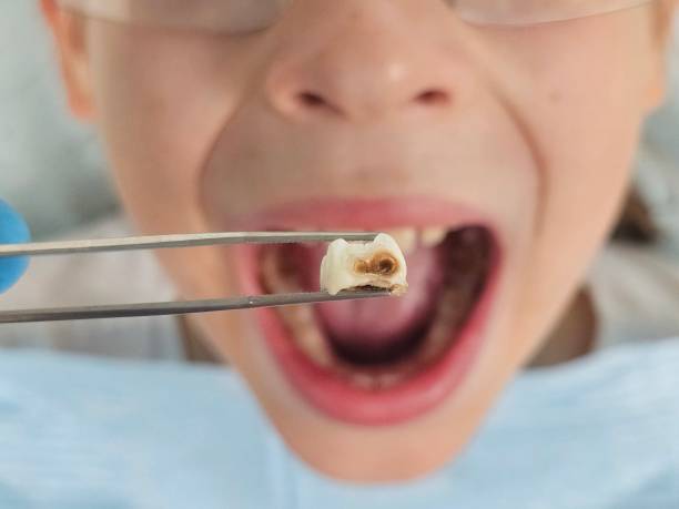Best Emergency Dental Care for Broken or Chipped Teeth in Jonesville, LA